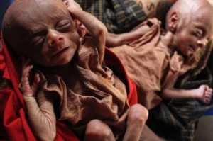 bayi kembar rohingya kurang gizi